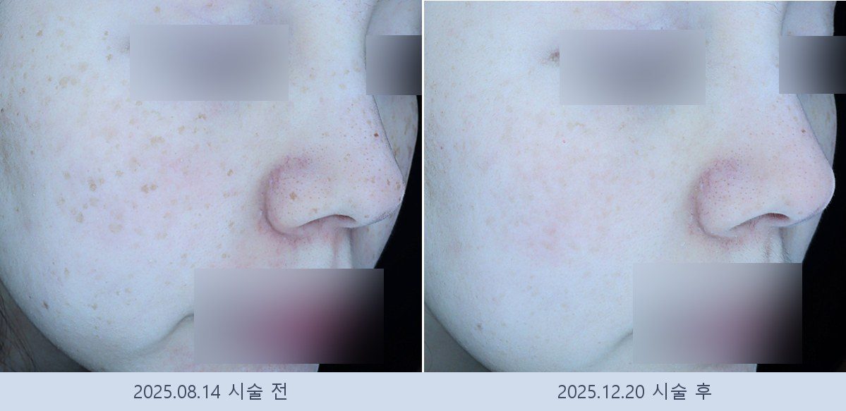 기미 잡티